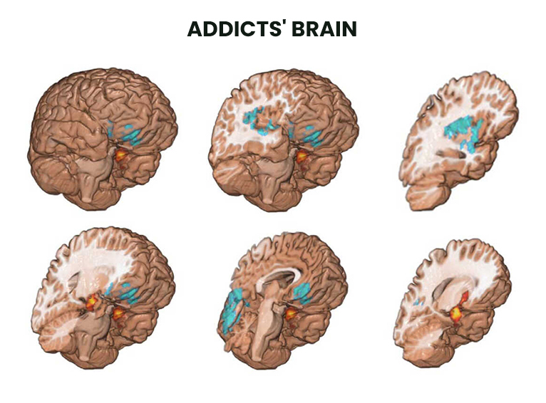 Addicts' Brain